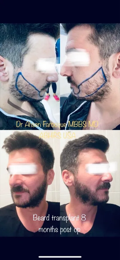 Man with a full, healthy beard after a beard hair transplant