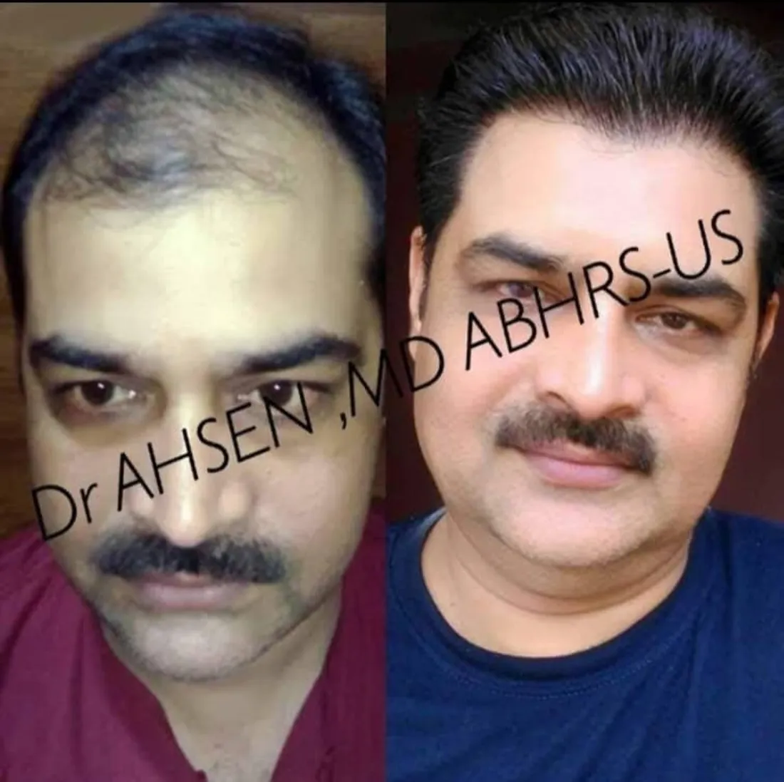 Man with a full, well defined beard after a beard hair transplant