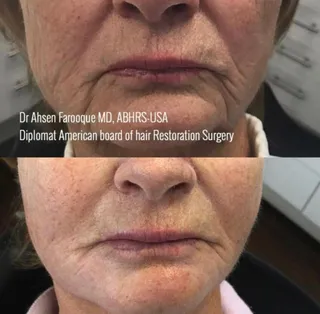 Full beard reconstruction