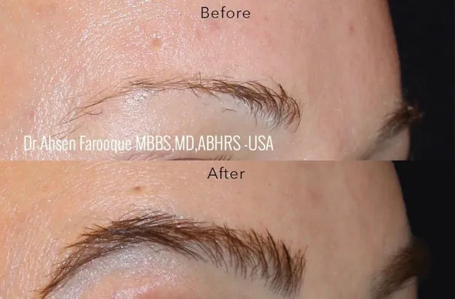 Eyebrow restoration