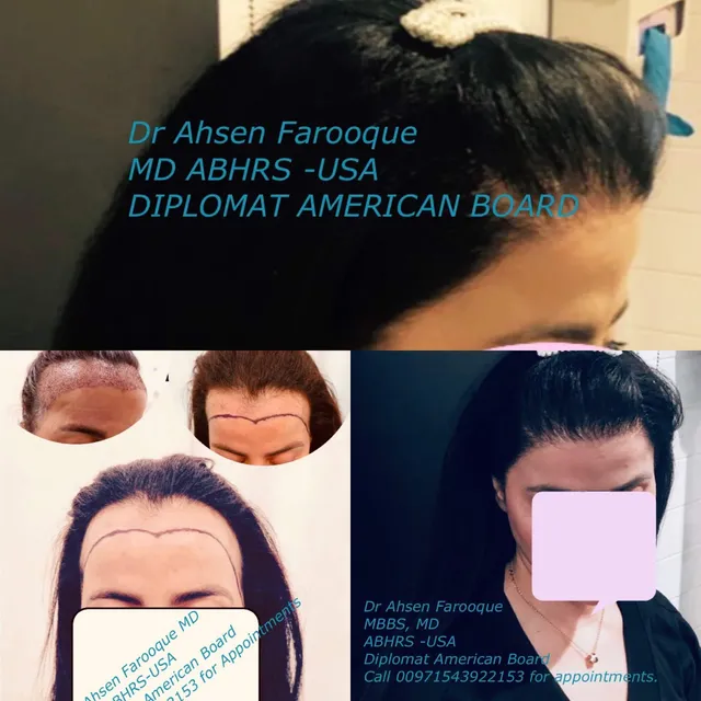 Natural brow reconstruction