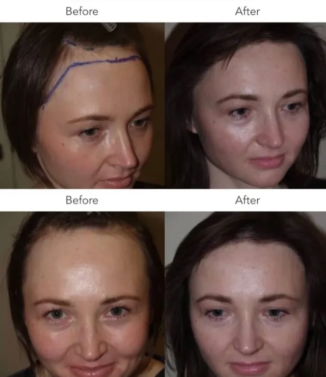 Hairline refinement, female
