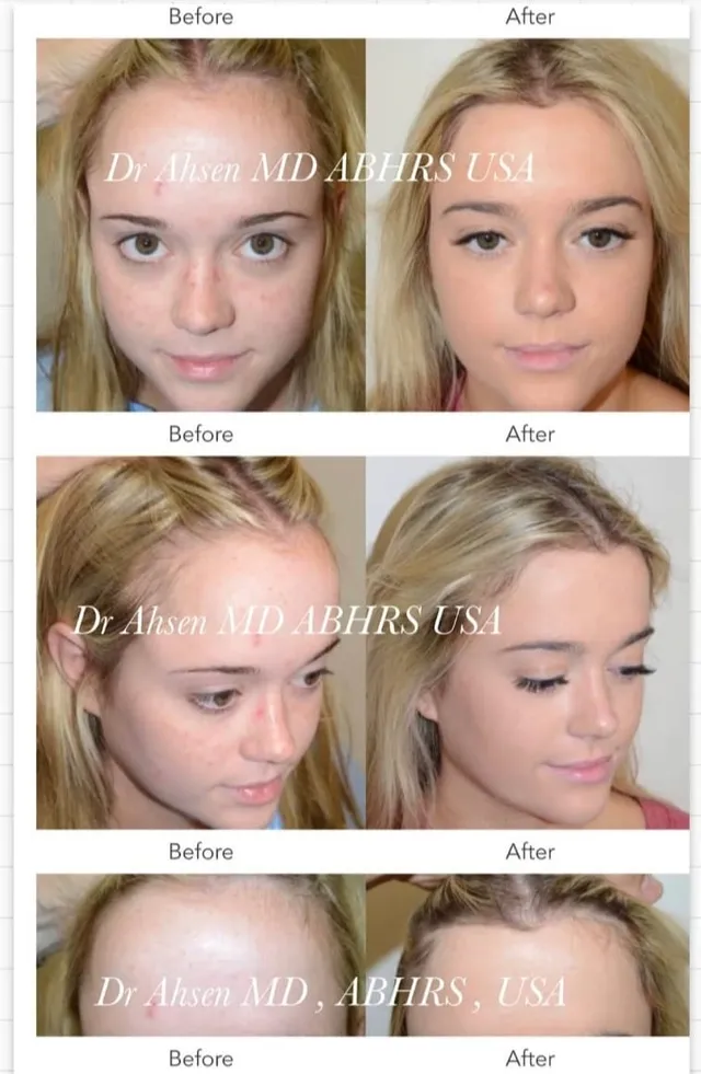 Diffuse thinning treated