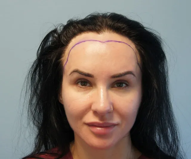 Hairline lowering