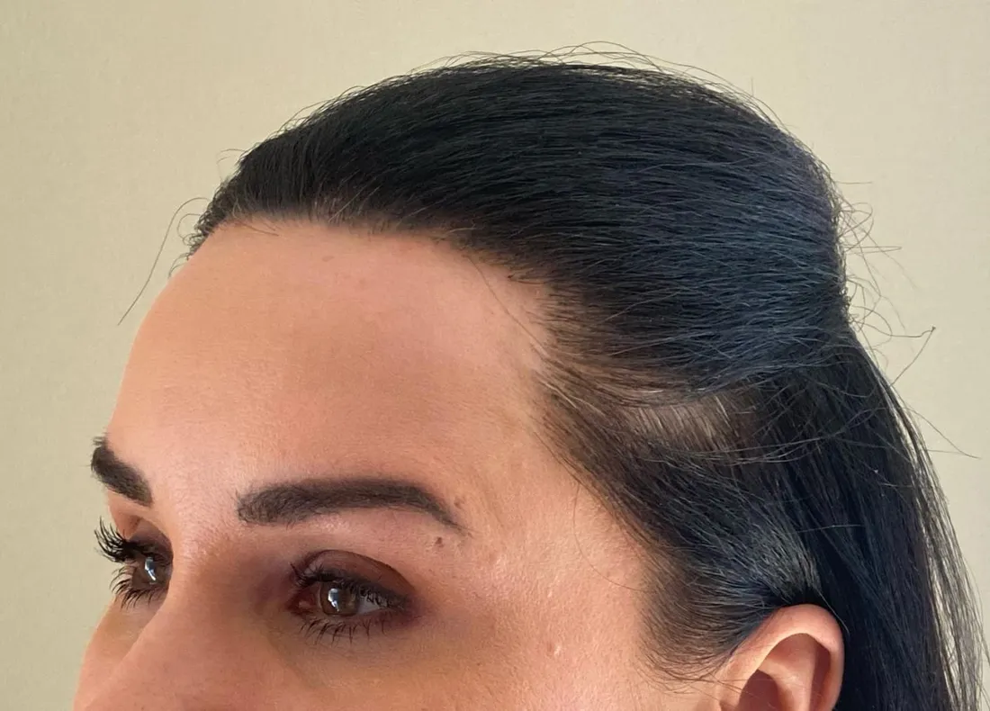 Woman with a restored, natural frontal hairline