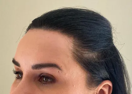 Woman with a restored, natural frontal hairline