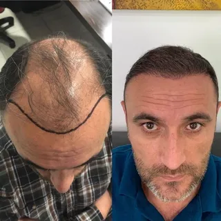 Hairline & frontal density, FUE
