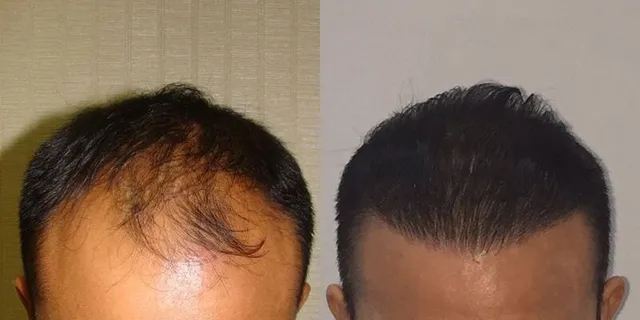 Receding hairline rebuilt