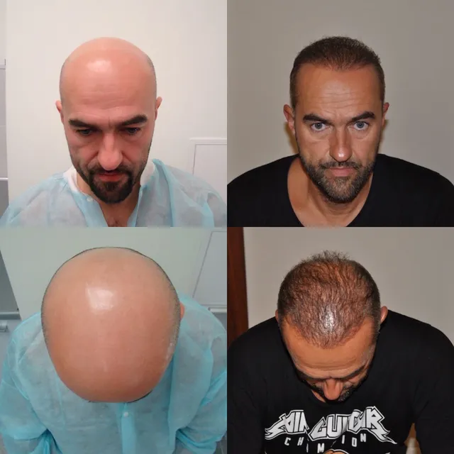 Crown restoration, DHI