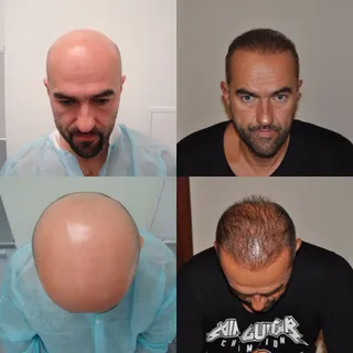 Crown restoration, DHI