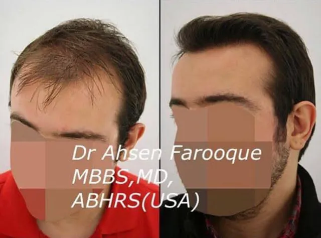 Mid-scalp density, Hybrid FUE