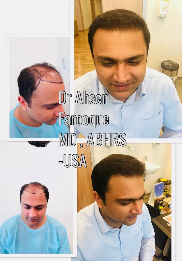 Natural hairline design