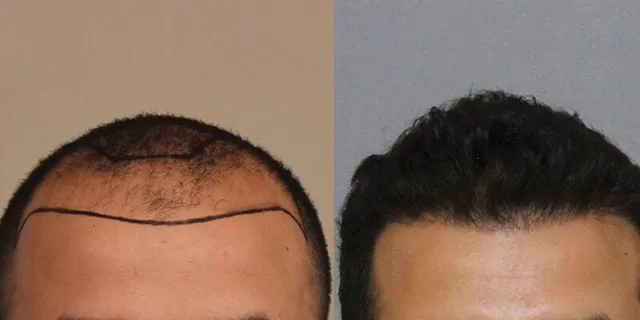 Temple & hairline FUE