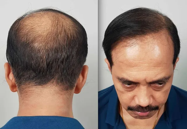 Advanced-loss restoration