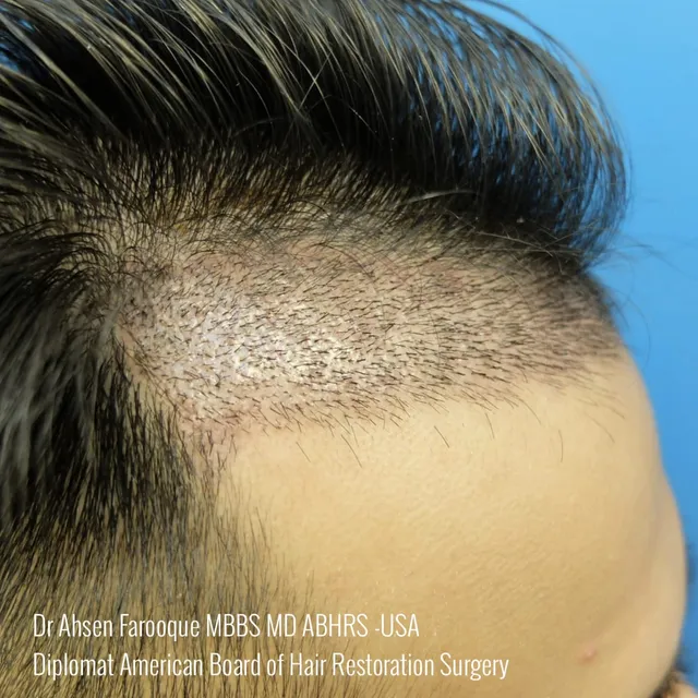 Natural hairline close-up