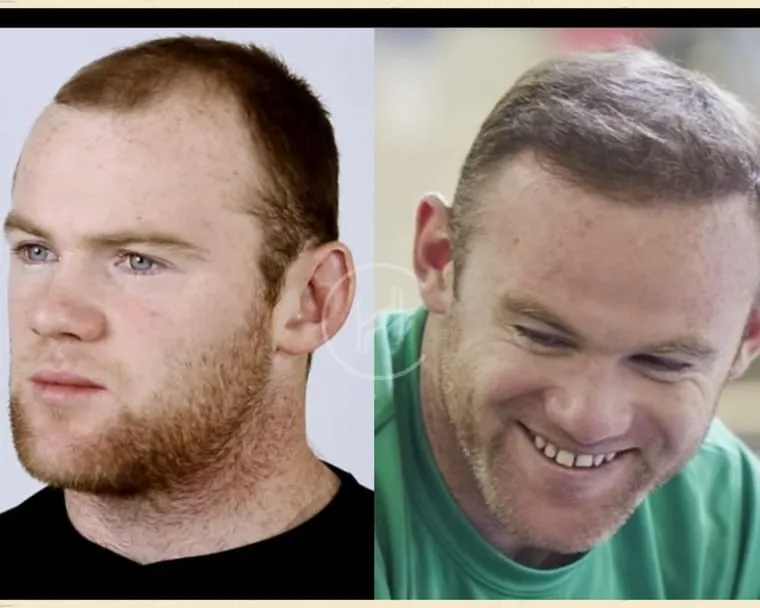 Wayne Rooney before and after his hair transplant