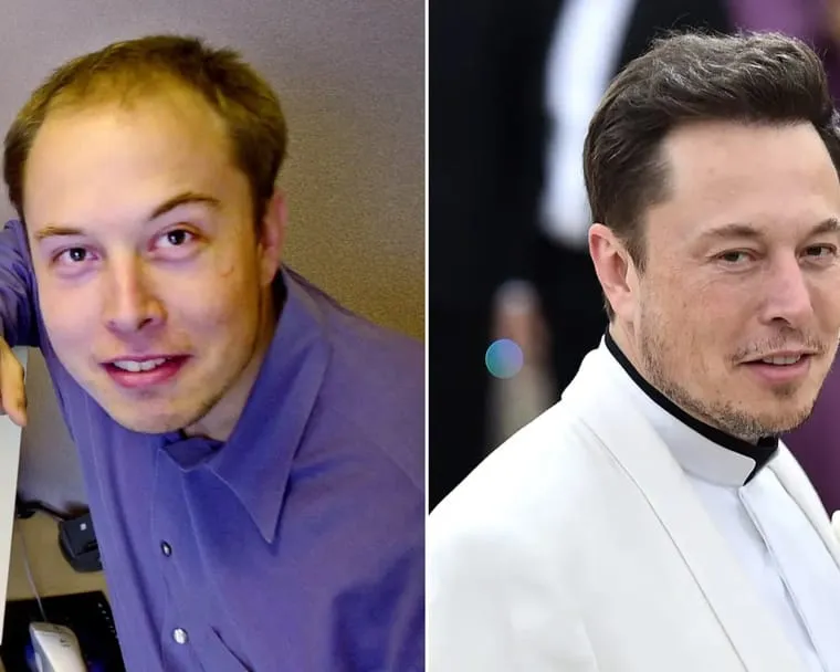 Elon Musk before and after hair restoration