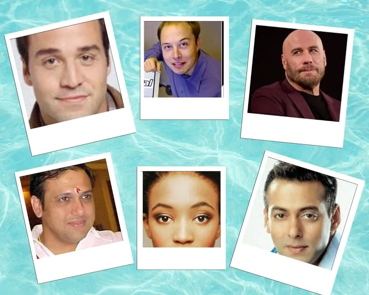 Celebrities before and after their hair transplants