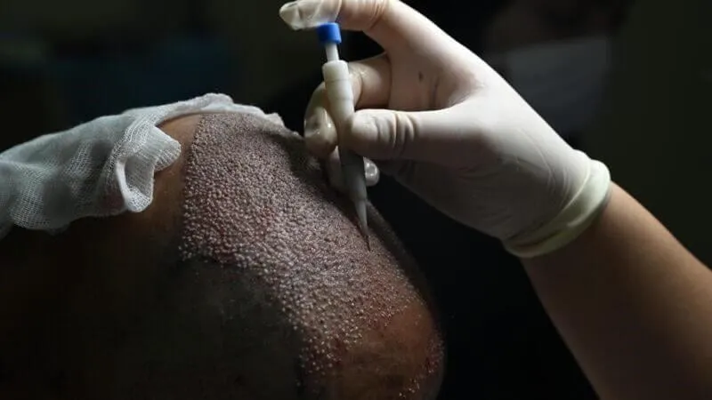 Direct hair implantation being performed with an implanter pen