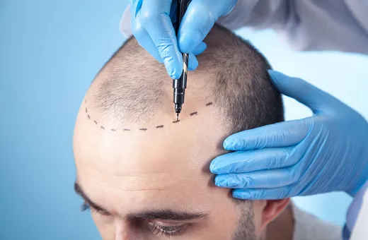 Planning your hairline