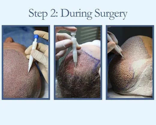 During surgery