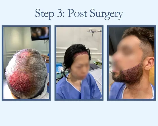After surgery