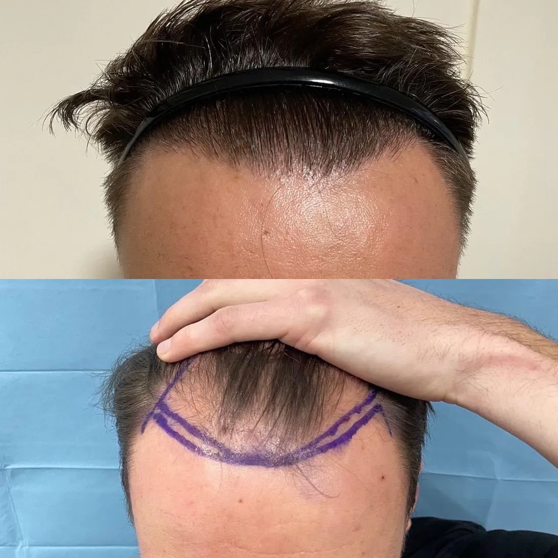 Surgeon marking a natural hairline design before a hair transplant