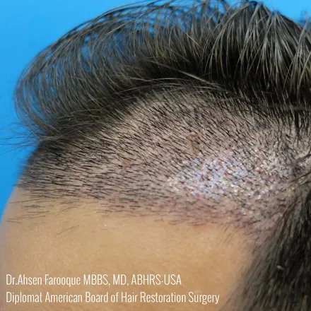 Detailed view of a natural, densely restored hairline