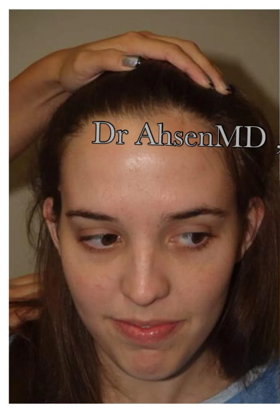 Female, frontal density, before