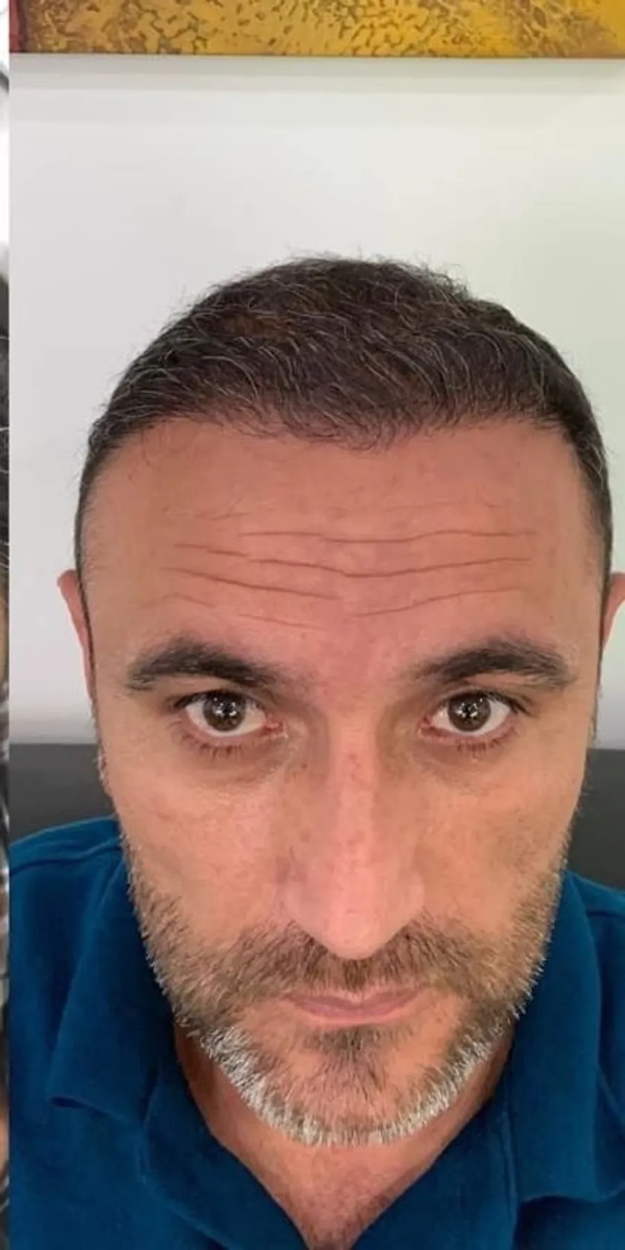 Male FUE, hairline & crown, after