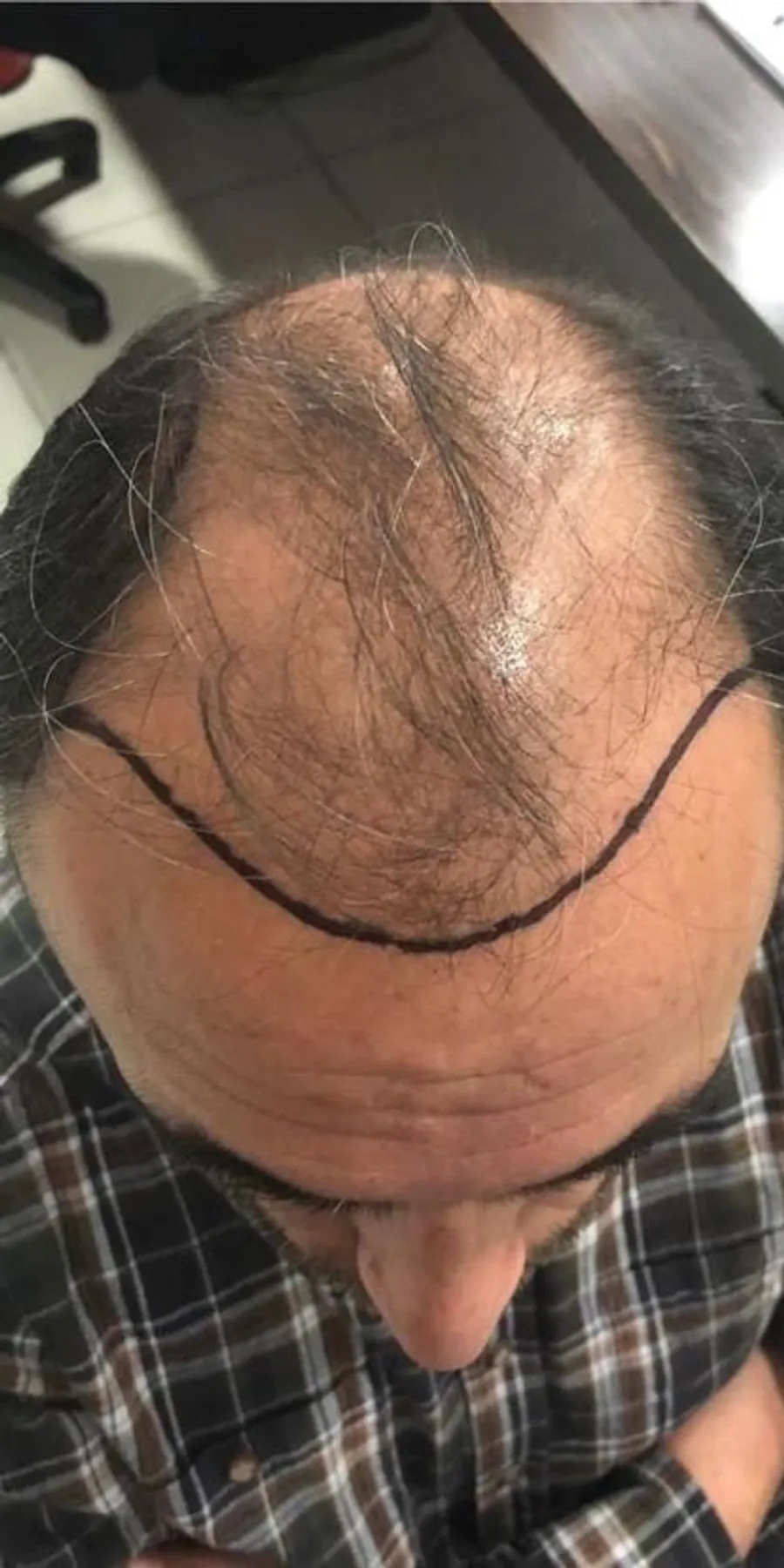 Male FUE, hairline & crown, before